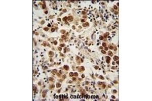 SOHLH1 Antibody (N-term) (ABIN654873 and ABIN2844530) immunohistochemistry analysis in formalin fixed and paraffin embedded human testis carcinoma followed by peroxidase conjugation of the secondary antibody and DAB staining.