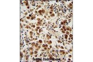 SOHLH1 Antibody (N-term) (ABIN654873 and ABIN2844530) immunohistochemistry analysis in formalin fixed and paraffin embedded human testis carcinoma followed by peroxidase conjugation of the secondary antibody and DAB staining. (SOHLH1 anticorps  (N-Term))