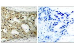 Immunohistochemical analysis of paraffin-embedded human breast carcinoma tissue using Androgen Receptor (Phospho-Ser650) antibody (E011120). (Androgen Receptor anticorps  (pSer650))