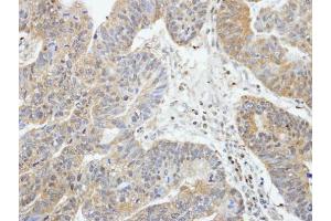 IHC-P Image Immunohistochemical analysis of paraffin-embedded human gastric cancer, using RIP2, antibody at 1:100 dilution. (RIPK2 anticorps)