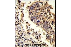 Formalin-fixed and paraffin-embedded human lung carcinoma reacted with LUC7L Antibody (C-term), which was peroxidase-conjugated to the secondary antibody, followed by DAB staining. (LUC7L anticorps  (C-Term))