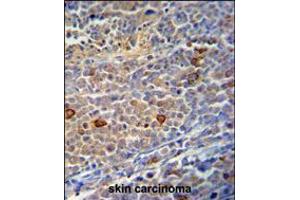 C9orf156 Antibody immunohistochemistry analysis in formalin fixed and paraffin embedded human skin carcinoma followed by peroxidase conjugation of the secondary antibody and DAB staining. (C9orf156 anticorps  (C-Term))