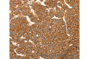 Immunohistochemistry of Human lung cancer using SFRP1 Polyclonal Antibody at dilution of 1:80 (SFRP1 anticorps)