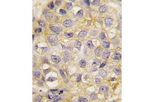 Formalin-fixed and paraffin-embedded human breast carcinoma tissue reacted with EphB2 antibody (C-term), which was peroxidase-conjugated to the secondary antibody, followed by DAB staining. (EPH Receptor B2 anticorps  (C-Term))