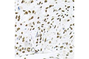 Immunohistochemistry of paraffin-embedded human lung cancer using MAPK8 antibody (ABIN5970116) at dilution of 1/100 (40x lens). (JNK anticorps)