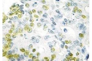Immunohistochemistry analyzes of C/EBP-α antibody in paraffin-embedded human colon carcinoma tissue. (CEBPA anticorps)