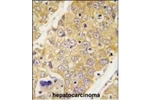 Formalin-fixed and paraffin-embedded human hepatocarcinoma tissue reacted with Dtnbp1 Antibody (C-term) (ABIN389170 and ABIN2839336) , which was peroxidase-conjugated to the secondary antibody, followed by DAB staining. (DTNBP1 anticorps  (C-Term))