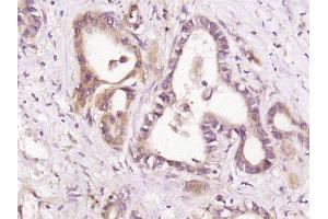Paraformaldehyde-fixed, paraffin embedded human stomach cancer, Antigen retrieval by boiling in sodium citrate buffer (pH6) for 15min, Block endogenous peroxidase by 3% hydrogen peroxide for 30 minutes, Blocking buffer (normal goat serum) at 37°C for 20min, Antibody incubation with HDPTP Polyclonal Antibody  at 1:400 overnight at 4°C, followed by a SP kit and DAB staining.