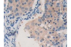Detection of ACAT2 in Human Lung cancer Tissue using Polyclonal Antibody to Acetyl Coenzyme A Acetyltransferase 2 (ACAT2)