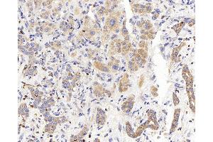 Immunohistochemistry analysis of paraffin-embedded human liver cancer using PERK Polyclonal Antibody at dilution of 1:400. (PERK anticorps)