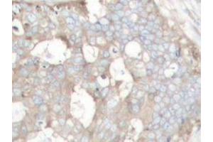Immunohistochemistry analyzes of Cortactin antibody in paraffin-embedded human prostate carcinoma tissue. (Cortactin anticorps)
