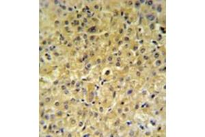 Immunohistochemistry analysis in formalin fixed and paraffin embedded hepatocarcinoma reacted with INSC Antibody (Center) followed by peroxidase conjugation of the secondary antibody and DAB staining. (INSC anticorps  (Middle Region))