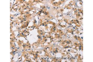 Immunohistochemistry of Human thyroid cancer using MARC1 Polyclonal Antibody at dilution of 1:40 (MOSC1 anticorps)
