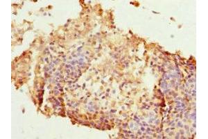 Immunohistochemistry of paraffin-embedded human cervical cancer using ABIN7165626 at dilution of 1:100 (HEXIM1 anticorps  (AA 210-359))