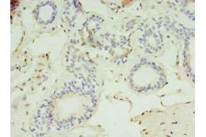 Immunohistochemistry of paraffin-embedded human breast cancer using ABIN7158756 at dilution of 1:100 (LYPLAL1 anticorps  (AA 2-237))