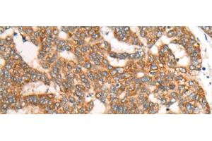 Immunohistochemistry of paraffin-embedded Human liver cancer tissue using CDON Polyclonal Antibody at dilution of 1:65(x200)