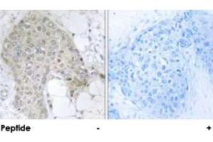 Immunohistochemical analysis of paraffin-embedded human breast carcinoma tissue using PPP1R2 polyclonal antibody . (PPP1R2 anticorps  (Ser120, Ser121))