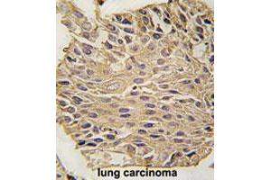 Formalin-fixed and paraffin-embedded human lung carcinomareacted with ALDOA polyclonal antibody , which was peroxidase-conjugated to the secondary antibody, followed by AEC staining. (ALDOA anticorps  (C-Term))
