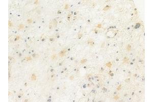 ABIN6264878 and ABIN6272422 at 1/100 staining human astrocytoma by IHC-P. (RTCD1 anticorps  (C-Term))