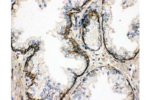 IHC-P: SSR3 antibody testing of human prostatic cancer tissue (SSR3 anticorps  (AA 8-23))