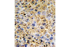 Formalin-fixed and paraffin-embedded human hepatocarcinoma with DCN Antibody , which was peroxidase-conjugated to the secondary antibody, followed by DAB staining. (Decorin anticorps  (AA 122-150))