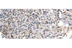 Immunohistochemistry of paraffin-embedded Human breast cancer tissue using KDM5C Polyclonal Antibody at dilution 1:45