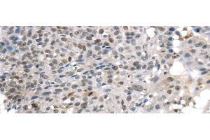 Immunohistochemistry of paraffin-embedded Human breast cancer tissue using KDM5C Polyclonal Antibody at dilution 1:45 (KDM5C anticorps)