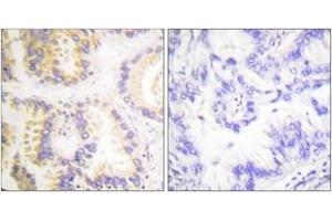 Immunohistochemistry analysis of paraffin-embedded human lung carcinoma, using Caspase 8 (Phospho-Ser347) Antibody. (Caspase 8 anticorps  (pSer347))