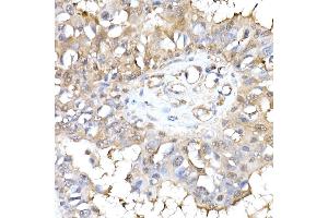 Immunohistochemistry of paraffin-embedded human breast cancer using HINT1 Rabbit mAb (ABIN7267663) at dilution of 1:50 (40x lens). (HINT1 anticorps)