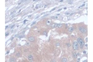 Detection of AST in Human Breast cancer Tissue using Monoclonal Antibody to Aspartate Aminotransferase (AST)