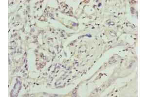 Immunohistochemistry of paraffin-embedded human pancreatic cancer using ABIN7161374 at dilution of 1:100 (GPM6B anticorps  (AA 1-64))