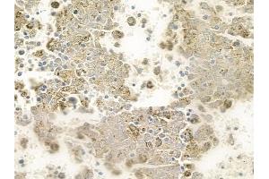 ABIN6259124 and ABIN6275293 at 1/100 staining human melanoma by IHC-P. (NEURL2 anticorps  (Internal Region))