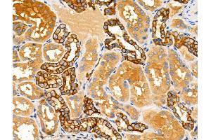 ABIN6258796 and ABIN6275126 at 1/100 staining Human kidney cancer and adjacent normal tissues by IHC-P.