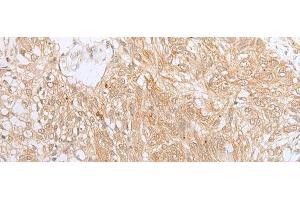 Immunohistochemistry of paraffin-embedded Human lung cancer tissue using ZNF34 Polyclonal Antibody at dilution of 1:40(x200) (ZNF34 anticorps)