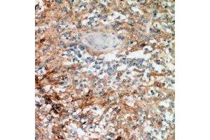 Immunohistochemical analysis of Nanos 1 staining in human breast cancer formalin fixed paraffin embedded tissue section. (Nanos Homolog 1 anticorps)