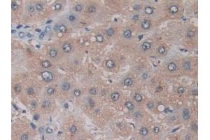 Detection of ADAM17 in Human Liver cancer Tissue using Monoclonal Antibody to A Disintegrin And Metalloprotease 17 (ADAM17)