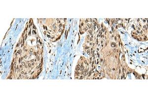 Immunohistochemistry of paraffin-embedded Human esophagus cancer tissue using CASK Polyclonal Antibody at dilution of 1:65(x200)