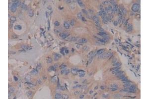 Detection of Rock2 in Human Colorectal cancer Tissue using Polyclonal Antibody to Rho Associated Coiled Coil Containing Protein Kinase 2 (Rock2)