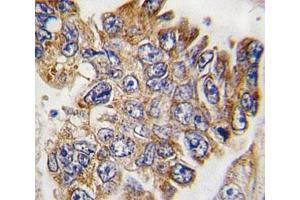 IHC analysis of FFPE human lung carcinoma tissue stained with GRB2 antibody (GRB2 anticorps  (AA 187-216))