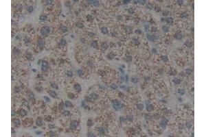 IHC-P analysis of Human Liver Cancer Tissue, with DAB staining. (Cytokeratin 1 anticorps  (AA 487-644))