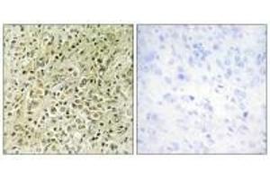 Immunohistochemistry analysis of paraffin-embedded human prostate carcinoma tissue, using RHG07 antibody. (DLC1 anticorps)