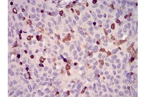 Immunohistochemical analysis of paraffin-embedded ovarian cancer tissues using WAS mouse mAb with DAB staining.