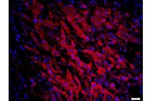 Paraformaldehyde-fixed, paraffin embedded human liver cancer, Antigen retrieval by boiling in sodium citrate buffer (pH6) for 15min, Block endogenous peroxidase by 3% hydrogen peroxide for 20 minutes, Blocking buffer (normal goat serum) at 37°C for 30min, Antibody incubation with CCR6 Polyclonal Antibody, Unconjugated  at 1:200 overnight at 4°C, followed by a conjugated secondary -AF594) at [1:500] for 90 minutes and DAPI staining of the nuclei.