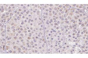 ABIN6277547 at 1/100 staining Human melanoma tissue by IHC-P. (AZGP1 anticorps  (Internal Region))