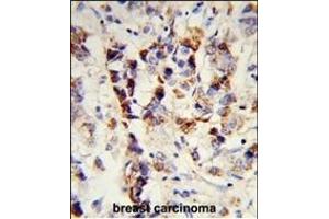 Formalin-fixed and paraffin-embedded human breast carcinoma reacted with SKIV2L2 Antibody (Center), which was peroxidase-conjugated to the secondary antibody, followed by DAB staining. (MTR4 anticorps  (AA 237-263))