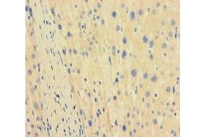 Immunohistochemistry of paraffin-embedded human liver cancer using ABIN7171563 at dilution of 1:100 (TBPL1 anticorps  (AA 1-185))
