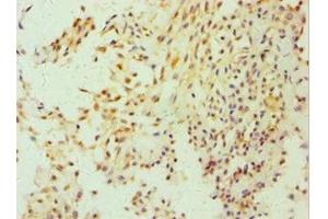 Immunohistochemistry of paraffin-embedded human breast cancer using ABIN7152857 at dilution of 1:100 (FGFBP1 anticorps  (AA 24-234))