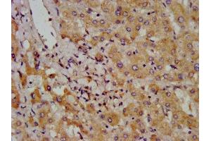 IHC image of ABIN7145800 diluted at 1:800 and staining in paraffin-embedded human liver cancer performed on a Leica BondTM system. (BAZ2B anticorps  (AA 139-240))