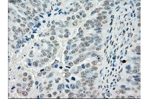 Immunohistochemical staining of paraffin-embedded Adenocarcinoma of colon tissue using anti-PORmouse monoclonal antibody. (POR anticorps)