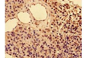 Immunohistochemistry of paraffin-embedded human glioma using ABIN7156842 at dilution of 1:100